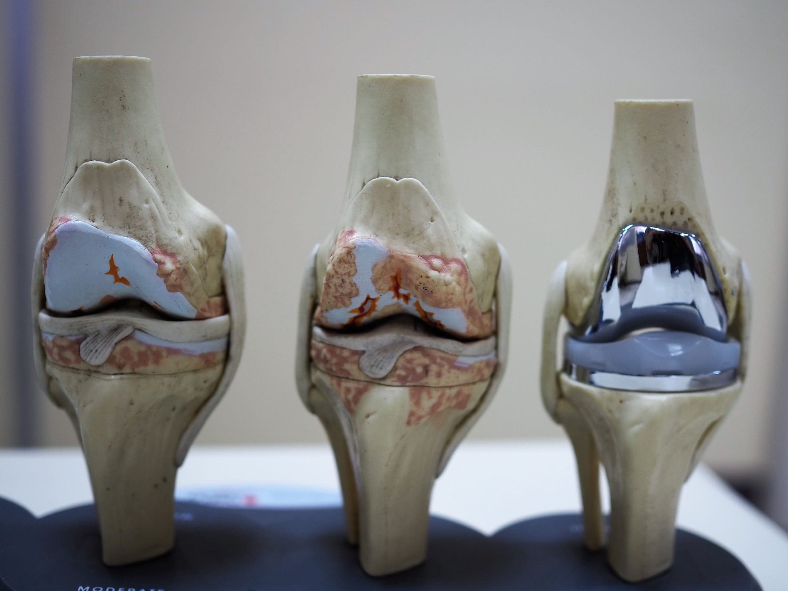 Knee replacement innovations in Asia Pacific